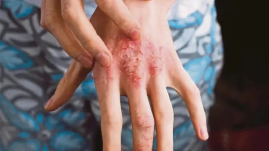 Panduan Ekzema & Dermatitis Pelajar 2026