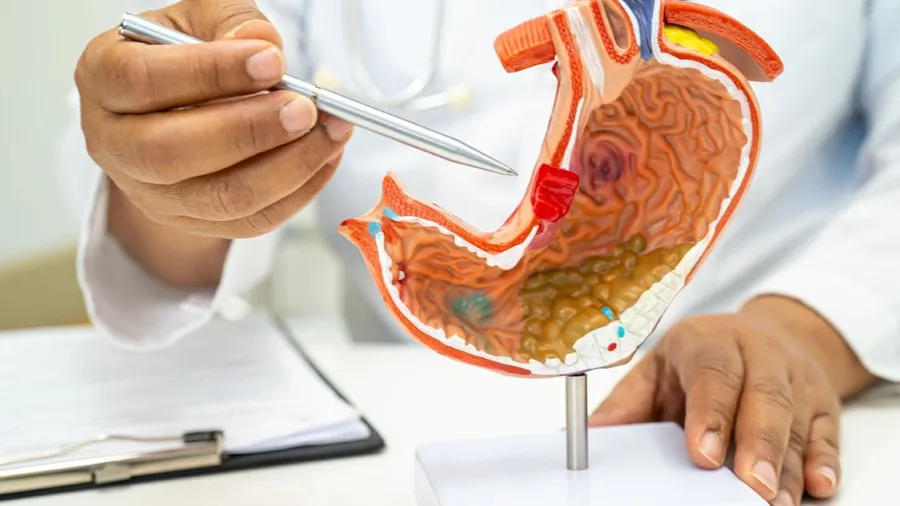 Panduan Lengkap Gastrik untuk Pelajar Universiti